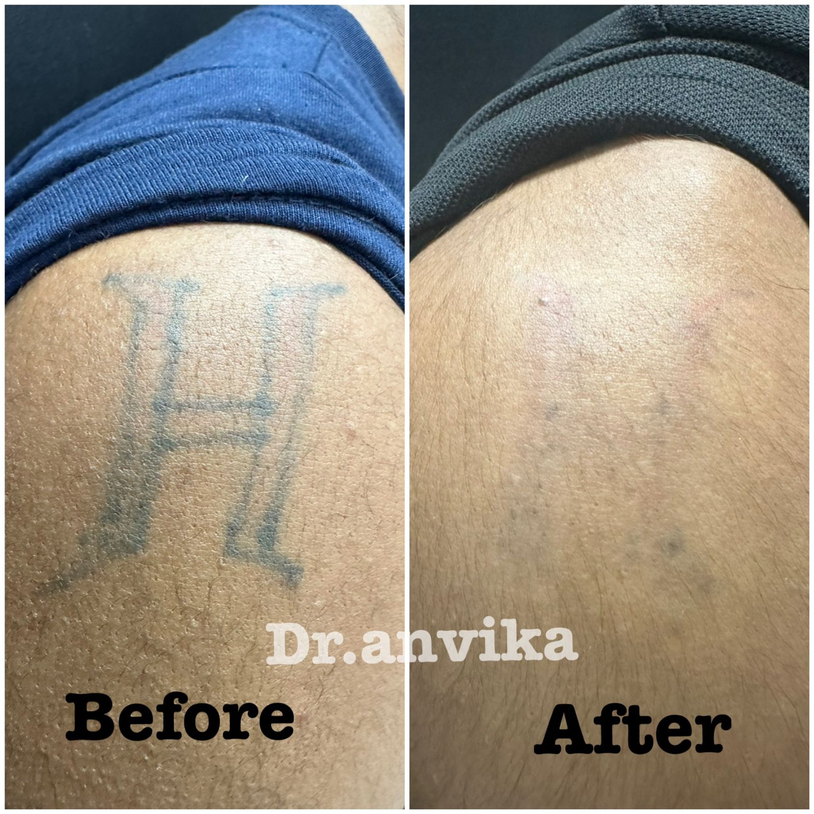 💥 Tattoo removal Excellent result after 4 treatments 🤩 @dr.annalisniak  🫶🏼 #tattooremoval #tattooremovalspecialist #tattooremovalclinic… |  Instagram